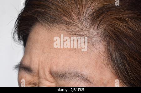 Skin creases or wrinkles at forehead of Southeast Asian, Myanmar or Burmese elder woman. Symptom of aging. Stock Photo