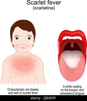 Scarlet fever. symptoms of scarlatina. Mouth with white coating on the ...