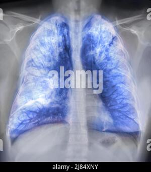 Lung 3D rendering image for diagnosis TB,tuberculosis and covid-19 from CT-Scanner 3D. Stock Photo