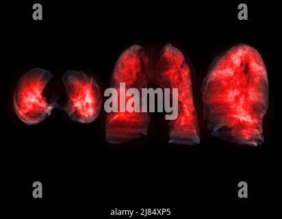 Collection of Lung 3D rendering image for diagnosis TB,tuberculosis and covid-19 from CT-Scanner 3D. Stock Photo