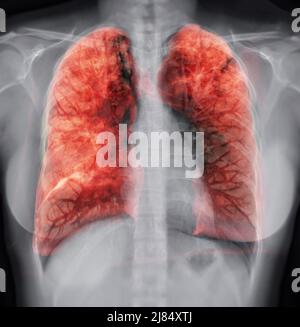 Lung 3D rendering image for diagnosis TB,tuberculosis and covid-19 from CT-Scanner 3D. Stock Photo