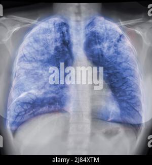 Lung 3D rendering image for diagnosis TB,tuberculosis and covid-19 from CT-Scanner 3D. Stock Photo