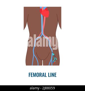 Femoral central venous catheter, illustration Stock Photo - Alamy