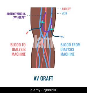 Dialysis shunt graft catheter, illustration Stock Photo - Alamy