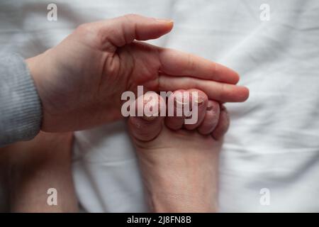Person with Raynaud and Ehlers-Danlos syndrome holding foot with swollen toes, very dry, flaky, damaged skin closeup Stock Photo
