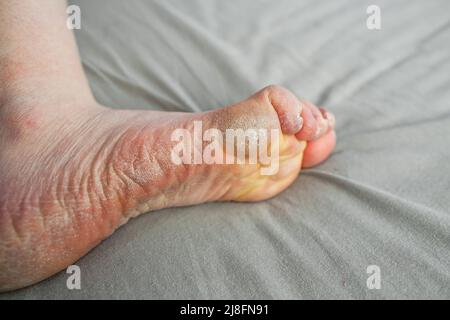 Foot of person with Raynaud's and Ehlers-Danlos syndrome (EDS) with damaged very dry cracking skin and calluses Raynaud’s phenomenon pale yellow sole Stock Photo