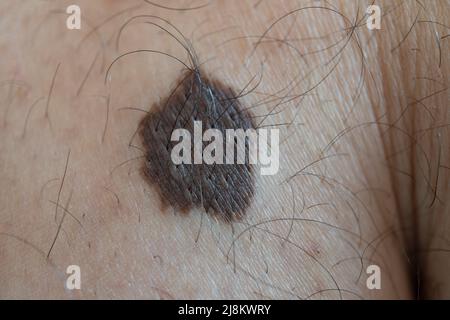 Big skin mole on the leg of a young guy. Macro picture. Stock Photo