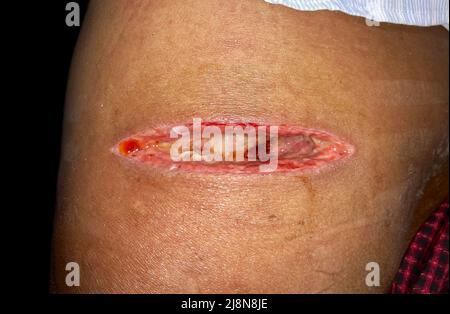 Post operation wound of injection abscess. Poor wound healing and Large gaping. Stock Photo