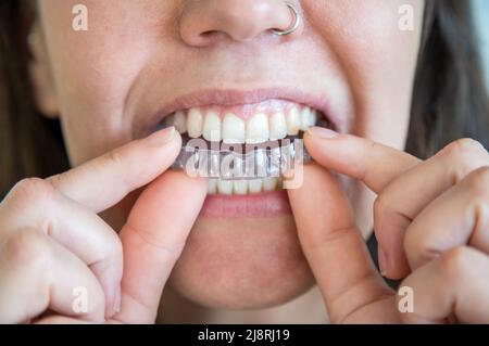 Título Young woman putting on an invisible dental aligner Stock Photo
