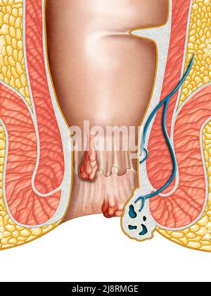 Anatomical drawing showing internal and external hemorrhoids. Digital illustration. Stock Photo