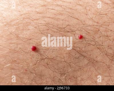 Close up photo of cherry angioma on human hairy skin Stock Photo