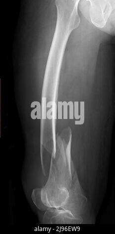 Comminuted femur fracture, X-ray Stock Photo