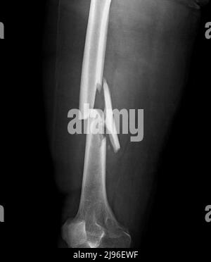 Comminuted femur fracture, X-ray Stock Photo