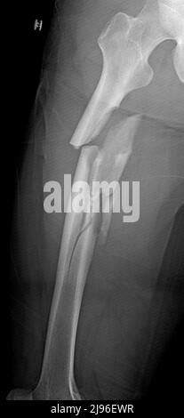 Comminuted femur fracture, X-ray Stock Photo