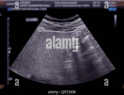 Ultrasound Upper Abdomen Showing Liver Stock Photo Alamy