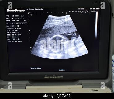 Cairo, Egypt, January 24 2018: A monitor of a portable ultrasonography showing the head of a fetus with a gestational age GA 18 weeks and 4 days durin Stock Photo