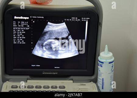 Cairo, Egypt, January 24 2018: A monitor of a portable ultrasonography showing the head of a fetus with a gestational age GA 18 weeks and 4 days durin Stock Photo