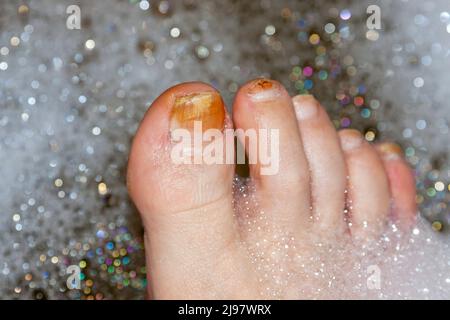 Diabetic foot Stock Photo