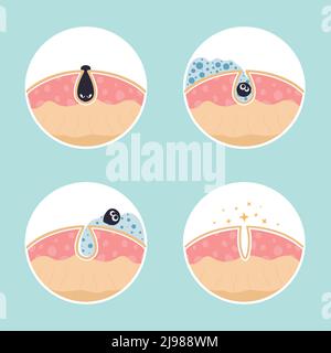 Cleaning clogged pores process flat vector illustration. Steps of blackheads, sebum or pimples removal, skin cleaning foam, skin care. Teenager skin. Shrinking and minimizing face pores concept. Stock Vector