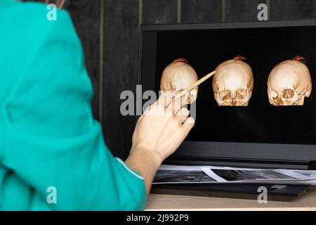 3D computed tomography of the brain with a fracture of the frontal part of the skull after injury on laptop screens on the table on laptop screens at Stock Photo