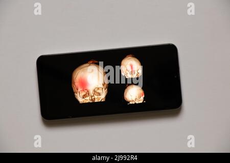 3D computed tomography of the brain with a fracture of the frontal part of the skull after injury on phone screens, mobile application Stock Photo