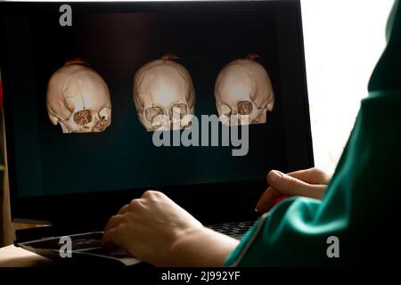 3D computed tomography of the brain with a fracture of the frontal part of the skull after injury on laptop screens on the table on laptop screens at Stock Photo