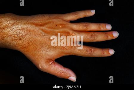 Monkeypox infection on hand with an acute rash with small blisters filled with fluid. Monkeypox is a viral zoonosis, symptoms similar to smallpox. Stock Photo