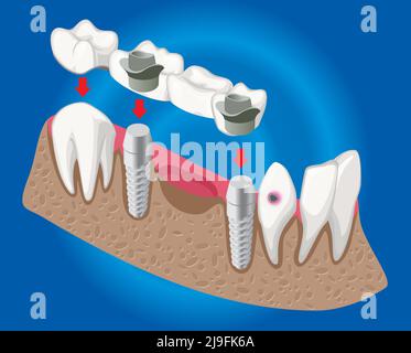 Isometric prosthetic dentistry concept with dental bridge used for missing teeth covering isolated vector illustration Stock Vector