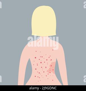 Caucasian short blonde hair woman with acne on her back. Skin problems concept.  Stock Vector