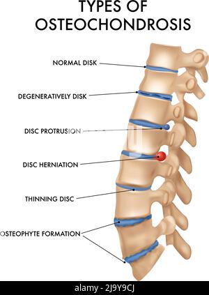 Vertebral column segment spinal  intervertebral hernia osteochondrosis pathology chart realistic medical education anatomy textbook poster vector illu Stock Vector