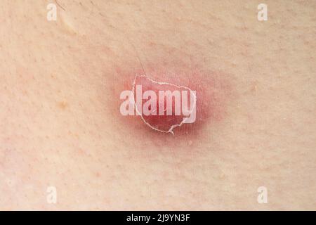Close-up of furuncle, acne, pimple with pus under skin Stock Photo