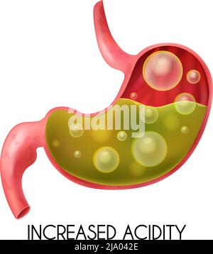 Pyrosis Cartoon Realistic medical illustration of pyrosis stomach isolated. Fire ...