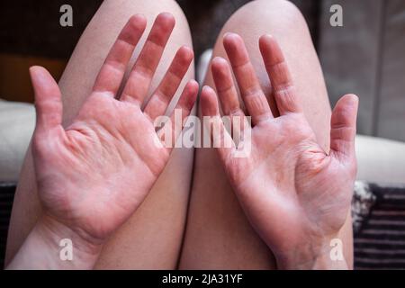Hands of young woman with Ehlers-Danlos and Raynaud's Syndrome, with very dry old looking skin, EDS skin wrinkled without being in water closeup Stock Photo