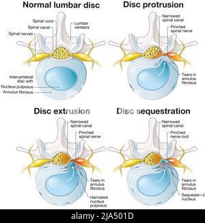 Illustration showing normal lumbar disc and disc protrusion and disc ...