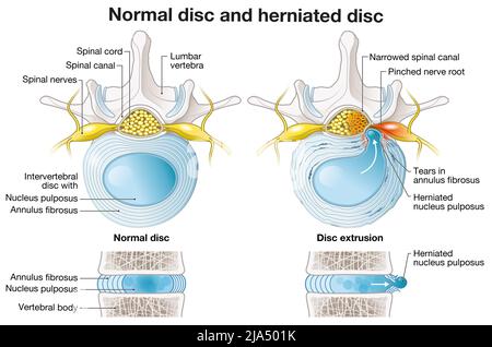 Illustration showing normal lumbar disc and disc protrusion and disc ...