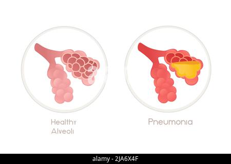 Human alveoli with pneumonia cartoon design human anatomy organ vector illustration on white background Stock Vector