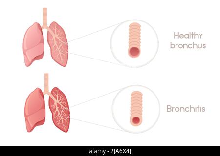 Human bronchi with bronchitis cartoon design human anatomy organ vector illustration on white background Stock Vector