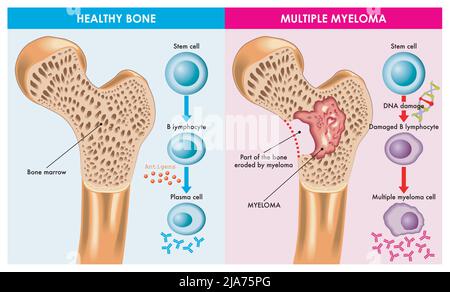 Medical illustration shows the difference between healthy bone and one that is eroded by multiple myeloma, which is caused by damaged DNA. Stock Vector