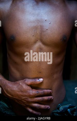 22 year old Elaich Meah shows bullet scars on his body. He was shot 25 times by the Indian Border Security Force (BSF) while he, and his coworkers Ashraful Islam and Shona Meah were extracting stones at the Kalidar Stone Quarry in Companyganj, Sylhet. He had to be hospitalized for 8 days. Companyganj, Sylhet, Bangladesh. Stock Photo