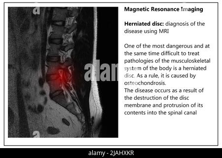 Computed tomography of the spine in a young man with a dorsal intervertebral hernia, diagnosis and detection of hernia and pain effects, banner layout Stock Photo