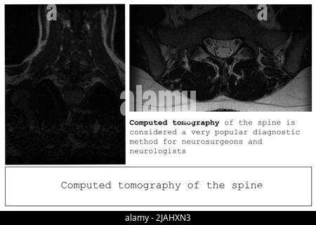 Computed tomography of the spine in a young man with a dorsal intervertebral hernia, diagnosis and detection of hernia and pain effects, banner layout Stock Photo