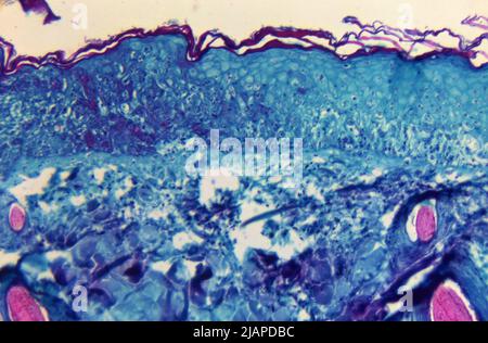Under a magnification of 125X, this image depicted a section of skin tissue, harvested from a lesion on the skin of a monkey, that had been infected with monkeypox virus. The specimen was obtained on day-4 of the rash development.  An optimised and enhanced version of an image produced by the US Centers for Disease Control and Prevention / credit CDC Stock Photo