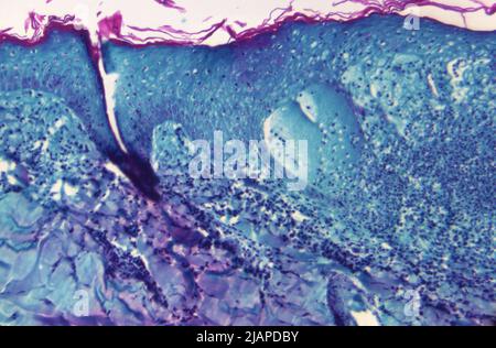 Under a magnification of 125X, this image depicted a section of skin tissue, harvested from a lesion on the skin of a monkey, that had been infected with monkeypox virus. The specimen was obtained on day-4 of the rash development.  An optimised and enhanced version of an image produced by the US Centers for Disease Control and Prevention / credit CDC Stock Photo