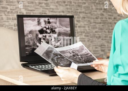 panoramic X-ray of children's teeth of two jaws, orthopantomogram of children's teeth on laptop screens at the doctor's table, diagnostics Stock Photo