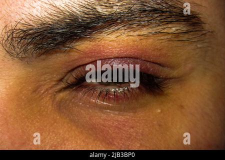 A person having a eye infection. Rennes city. Illustrations of the city of Rennes. France. Stock Photo