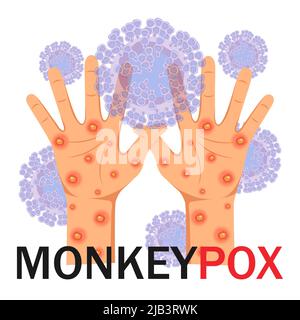 Monkeypox virus. Human hands with a rash on a microbiological background with text. Monkeypox concept. Vector illustration. Stock Vector