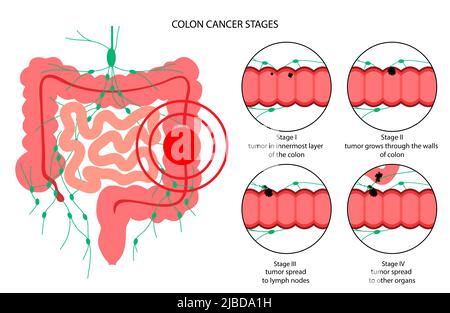 Illustration of the stages of colorectal cancer tumour development ...