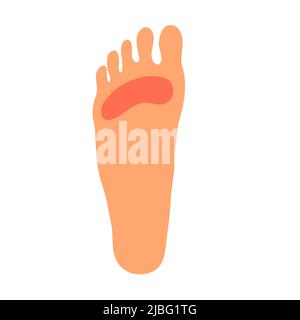 A woman leg with a sore callus. Transverse flat feet. Orthopedic disease. Foot health problems. Vector illustration isolated on white background Stock Vector