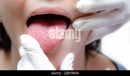 Tongue of a young Caucasian woman with benign migratory glossitis, held by a doctor wearing white gloves. Tongue with candidiasis. Cracks in the tongu Stock Photo