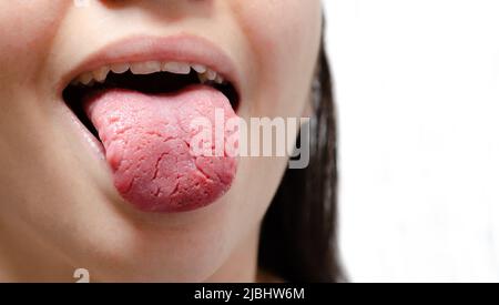 Tongue of a young Caucasian woman with benign migratory glossitis. ongue with candidiasis. Cracks in the tongue. Stock Photo